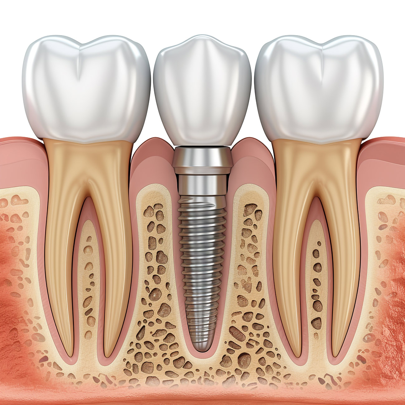 Dentalist Medikal implant DENTALİST MEDİKAL dentalistmed www.dentalistmed.com info@dentalistmed.com 05399280551